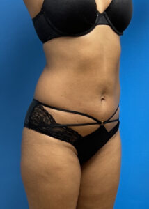 Liposuction with Renuvion Before & After Pictures near Fort Lauderdale, FL