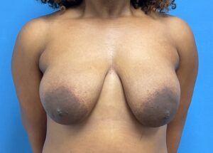 Breast Lift Before & After Pictures near Fort Lauderdale, FL