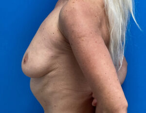 Breast Augmentation Before & After Pictures near Fort Lauderdale, FL