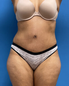 Tummy Tuck Before & After Pictures near Fort Lauderdale, FL