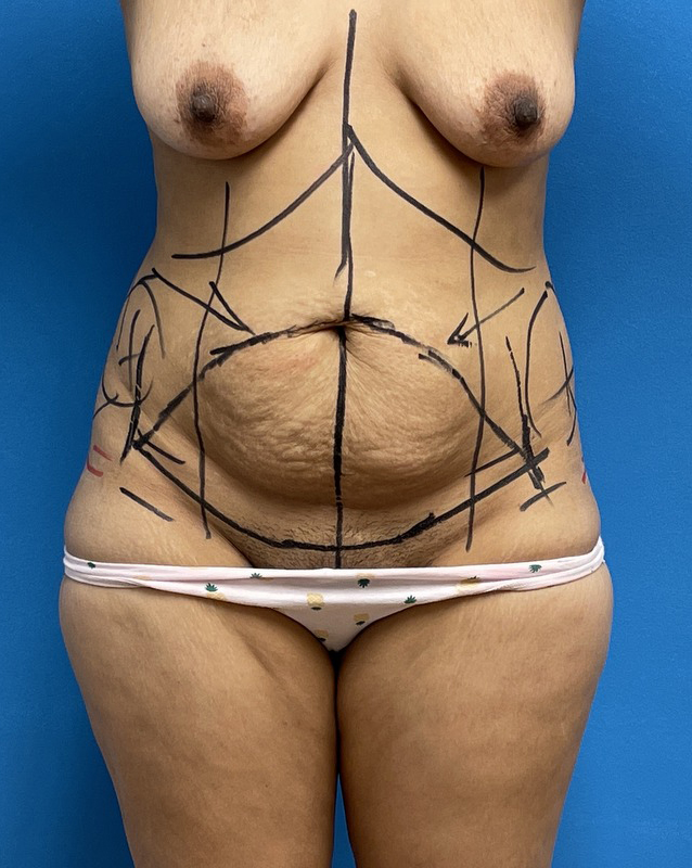 10172022 173000 (10) Tummy Tuck Before & After Pictures near Fort Lauderdale, FL