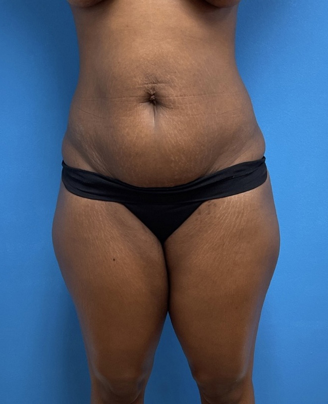 Liposuction with Renuvion Before & After Pictures near Fort Lauderdale, FL