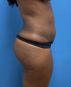 Liposuction with Renuvion Before & After Pictures near Fort Lauderdale, FL