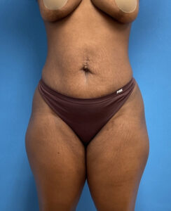 Liposuction with Renuvion Before & After Pictures near Fort Lauderdale, FL