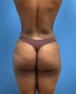 Liposuction with Renuvion Before & After Pictures near Fort Lauderdale, FL