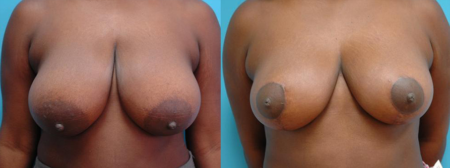 Breast-Reduction-patient3