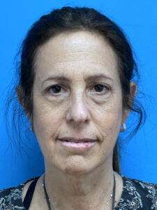 Facelift Before & After Pictures near Fort Lauderdale, FL