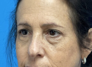 Blepharoplasty Before and After Pictures Fort Lauderdale, FL