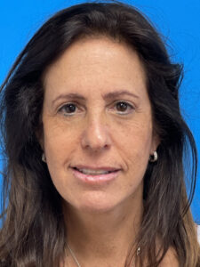 Facelift Before & After Pictures near Fort Lauderdale, FL