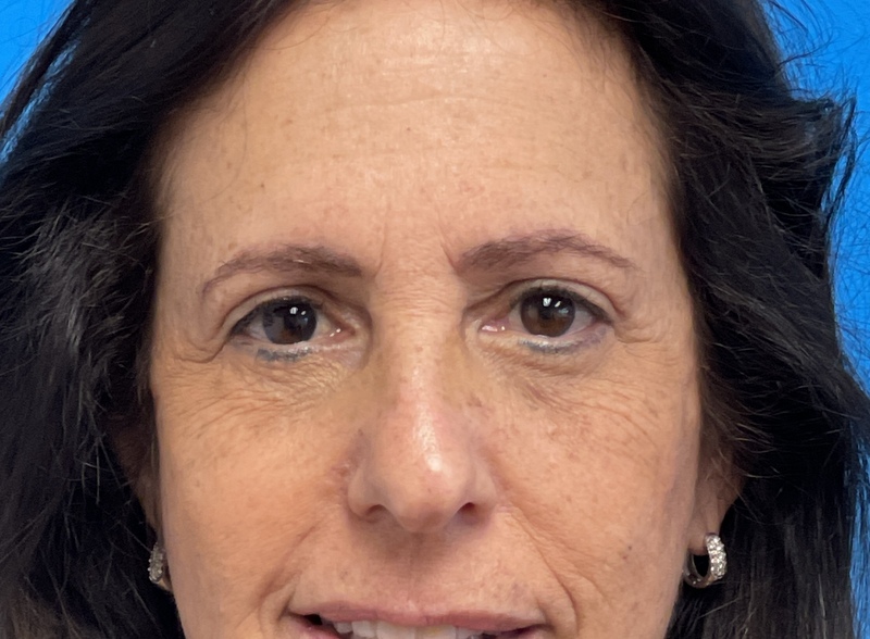 Blepharoplasty Before and After Pictures Fort Lauderdale, FL