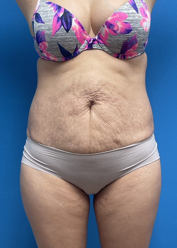 Tummy Tuck Before & After Pictures near Fort Lauderdale, FL