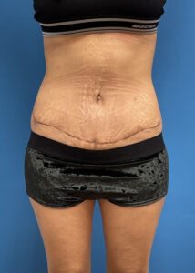 Tummy Tuck Before & After Pictures near Fort Lauderdale, FL