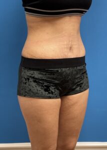 Tummy Tuck Before & After Pictures near Fort Lauderdale, FL