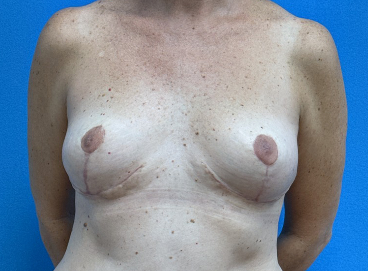 Breast Implant Removal Before & After