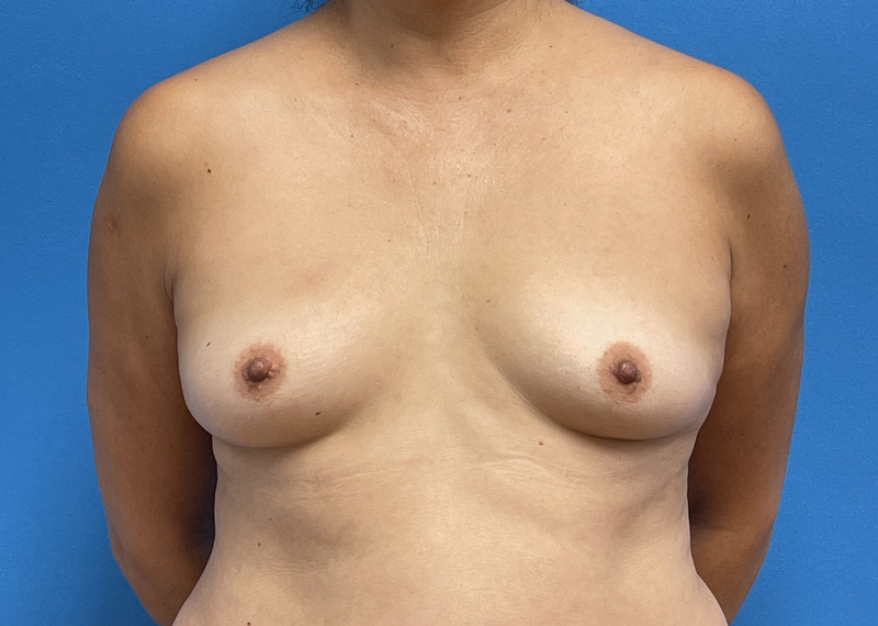 Breast Augmentation Before & After Pictures near Fort Lauderdale, FL