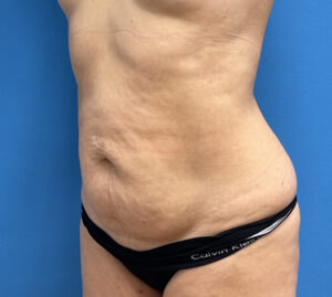 Tummy Tuck Before & After Pictures near Fort Lauderdale, FL