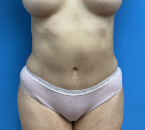 Tummy Tuck Before & After Pictures near Fort Lauderdale, FL