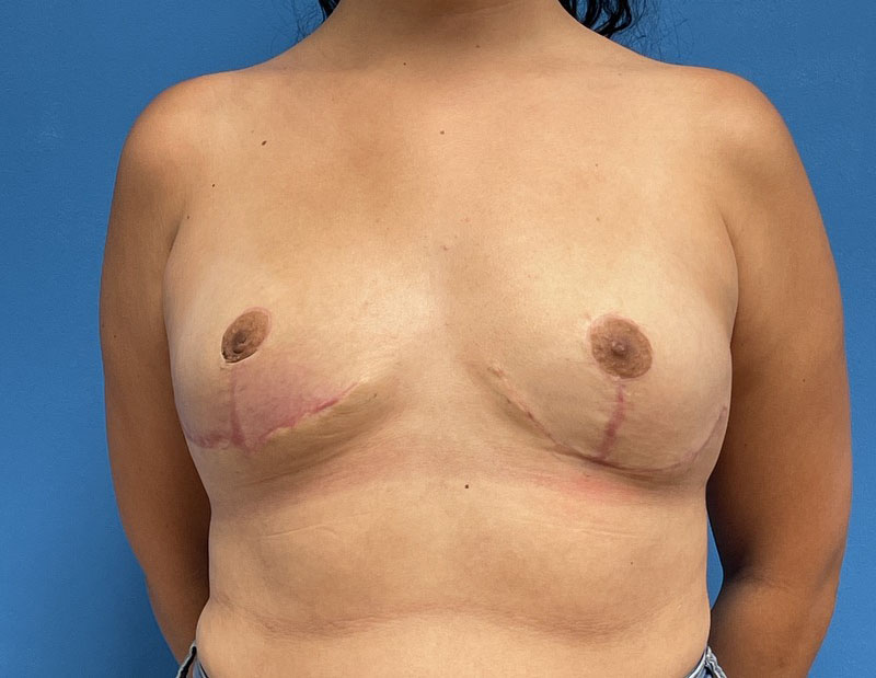 Breast Implant Removal Before & After Pictures near Fort Lauderdale, FL