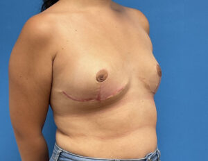 Breast Implant Removal Before & After Pictures near Fort Lauderdale, FL