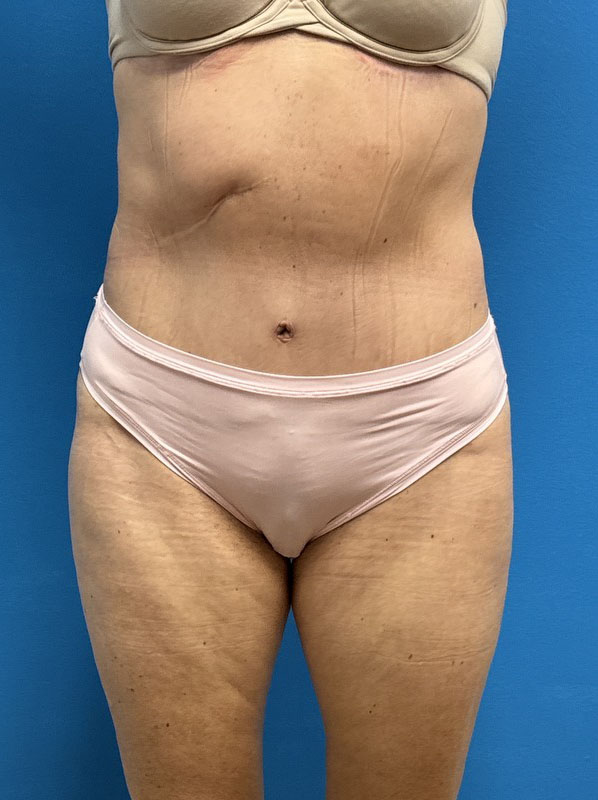 Tummy Tuck Before & After Pictures near Fort Lauderdale, FL