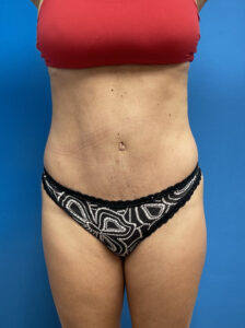 Tummy Tuck Before & After Pictures near Fort Lauderdale, FL