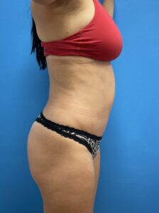 Tummy Tuck Before & After Pictures near Fort Lauderdale, FL