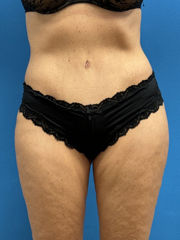 Tummy Tuck Before & After Pictures near Fort Lauderdale, FL