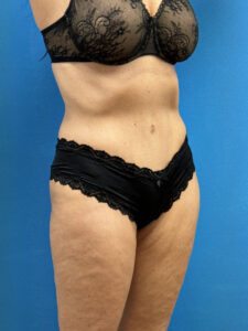 Tummy Tuck Before & After Pictures near Fort Lauderdale, FL