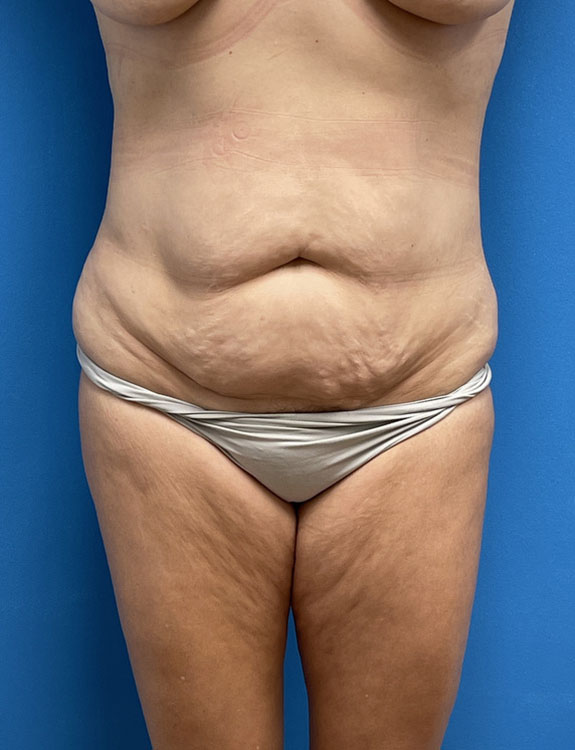 Tummy Tuck Before & After Pictures near Fort Lauderdale, FL