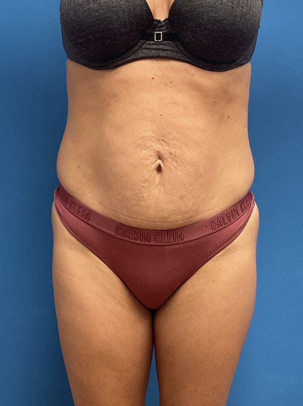 Tummy Tuck Before & After Pictures near Fort Lauderdale, FL