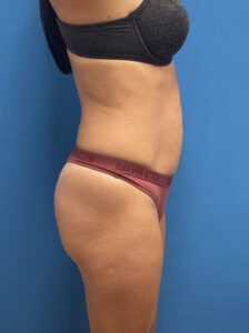 Tummy Tuck Before & After Pictures near Fort Lauderdale, FL