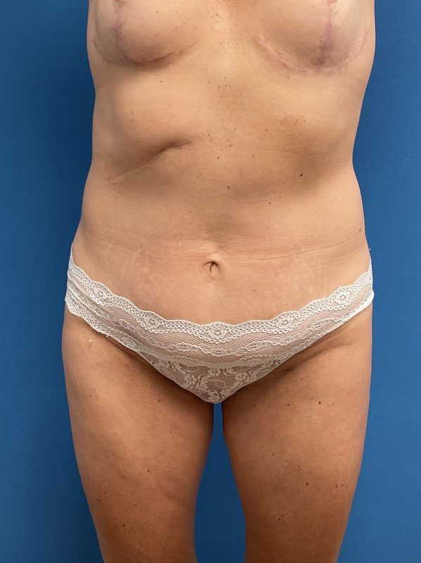 Tummy Tuck Before & After Pictures near Fort Lauderdale, FL