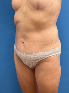 Tummy Tuck Before & After Pictures near Fort Lauderdale, FL