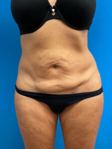 Tummy Tuck Before & After Pictures near Fort Lauderdale, FL