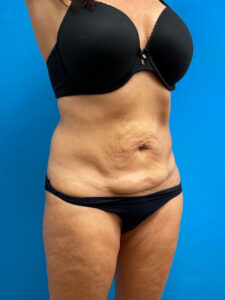 Tummy Tuck Before & After Pictures near Fort Lauderdale, FL