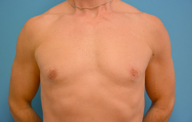 Gynecomastia Before and After Pictures Fort Lauderdale, FL