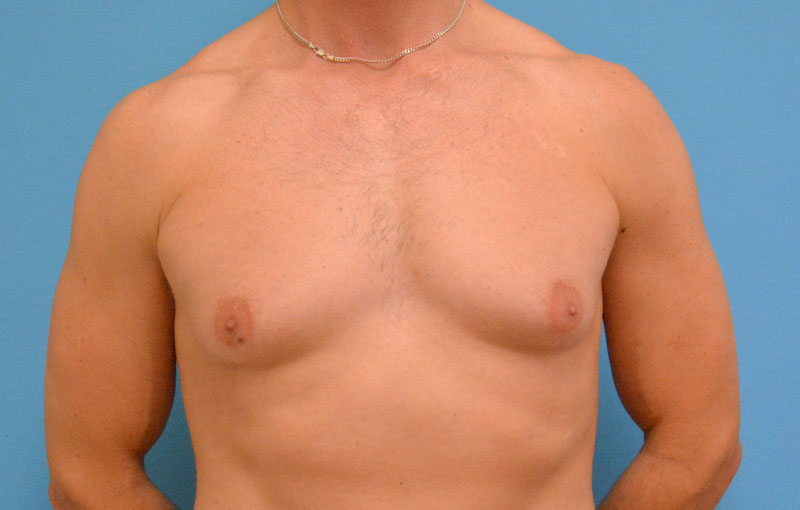 Gynecomastia Before and After Pictures Fort Lauderdale, FL