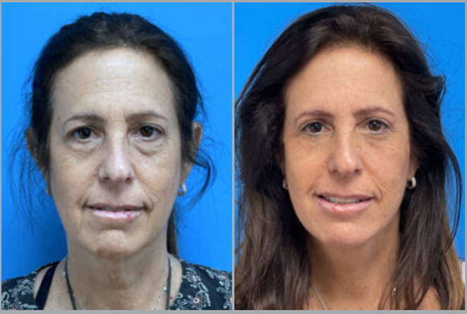 Facelift Before and After Pictures Fort Lauderdale, FL