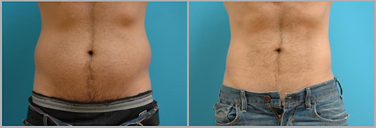 Male Liposuction Before and After Pictures Fort Lauderdale, FL