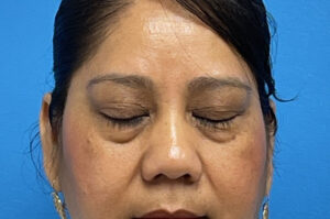 Blepharoplasty Before and After Pictures Fort Lauderdale, FL