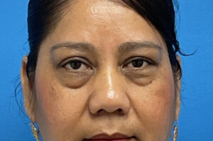 Blepharoplasty Before and After Pictures Fort Lauderdale, FL