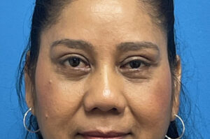 Blepharoplasty Before and After Pictures Fort Lauderdale, FL