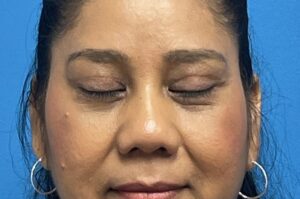 Blepharoplasty Before and After Pictures Fort Lauderdale, FL