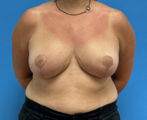 Breast Reduction Before & After Pictures near Fort Lauderdale, FL