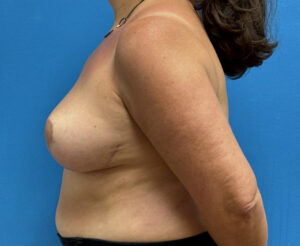 Breast Reduction Before & After Pictures near Fort Lauderdale, FL