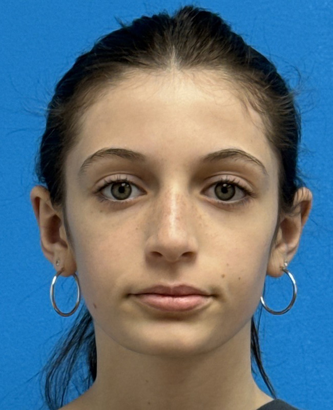 Otoplasty Before and After Pictures Fort Lauderdale, FL