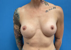 Breast Implant Revision/Replacement Before & After Pictures near Fort Lauderdale, FL