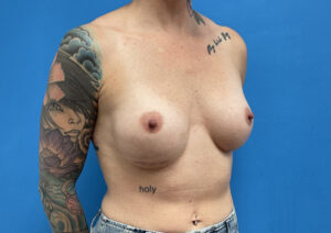 Breast Implant Revision/Replacement Before & After Pictures near Fort Lauderdale, FL