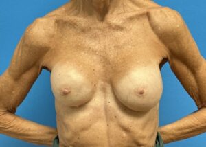 Breast Implant Revision/Replacement Before & After Pictures near Fort Lauderdale, FL