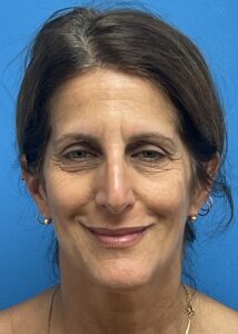 Blepharoplasty Before & After Pictures near Fort Lauderdale, FL